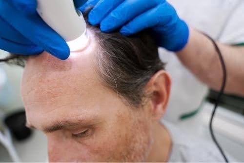 is hair transplant permanent
